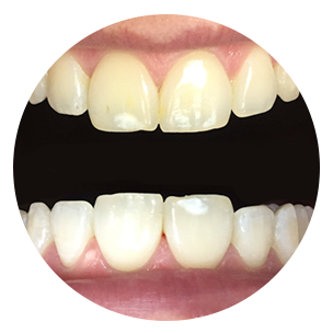 Clareamento Dentário