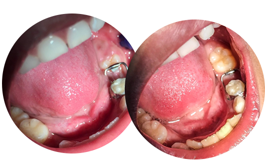 Procedimento de Ulectomia