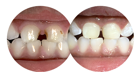 Procedimento de Restauração dentária em Dente de Leite