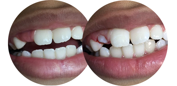 Procedimento de Ulectomia